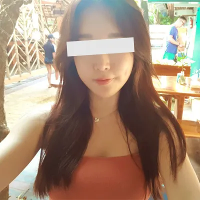 ★頬骨縮小手術1年半後のレビュー★