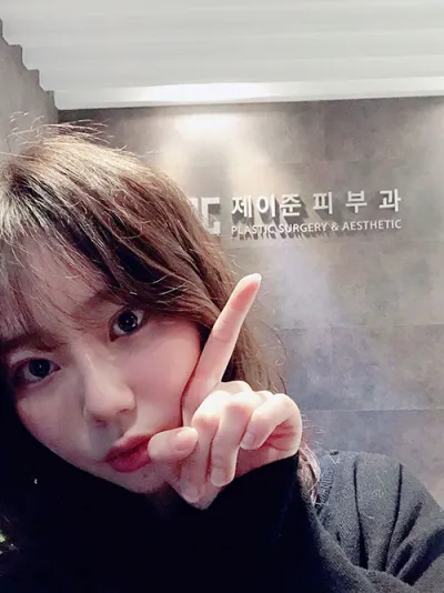 輪郭注射を受けました