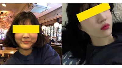 輪郭矯正 - 頬骨縮小術を受けました!