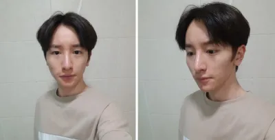 輪郭矯正、鼻整形、フルフェイス脂肪移植