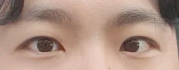 男性の目つき矯正（目頭切開含む、切開）を受けました〜！！
