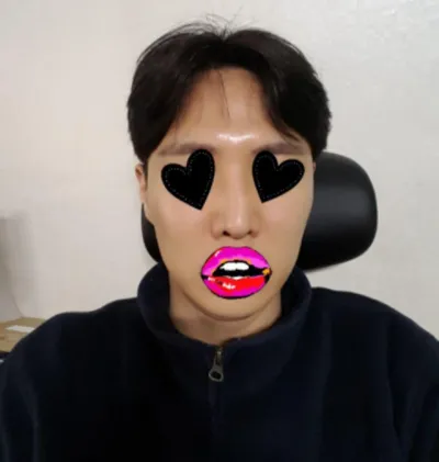 内視鏡的額リフト（エンドタイン）、鼻再手術（鼻筋、鼻先）、わし鼻矯正、鼻孔下降