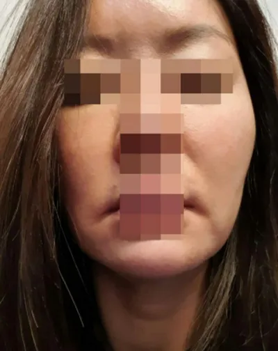 目の下の脂肪移植、フェイスリフト