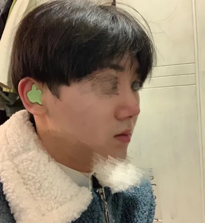 鼻再手術（鼻筋、鼻先）、小鼻縮小