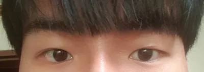 部分切開による眼瞼下垂修正再手術