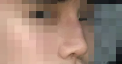 鼻筋、鼻先、ハンプ、鼻骨縮小
