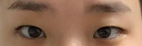 二重まぶた（埋没法）、目頭切開