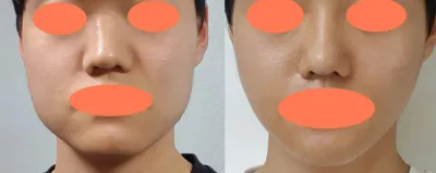 エラ削り、皮質骨切除、咬筋縮小