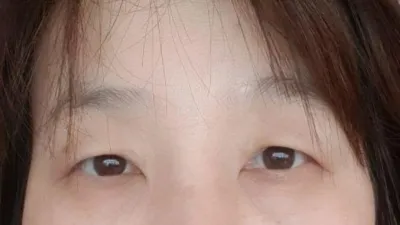 埋没法二重、下眼瞼、上眼瞼の手術を受けました