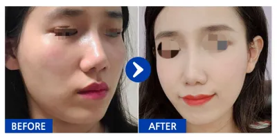 [バビトーク] 輪郭整形 / 3ヶ月目 / ニックネーム：dbdbdla