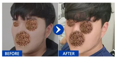 [バビトーク] 輪郭整形 / 3ヶ月目 / ニックネーム：アンヌンウン