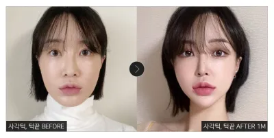 [カンナムオンニ レビュー] エラ、顎先整形1ヶ月目 / ニックネーム：クマの三兄弟