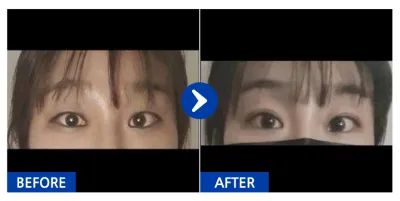 [バビトーク] 二重 / 3ヶ月目 / ニックネーム：tilia20