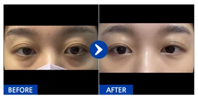 [バビトーク] 目の下の脂肪再配置 / 1ヶ月目 / ニックネーム：ヌンヌンオンオン