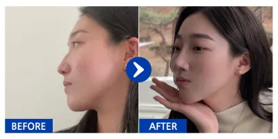 [バビトーク] 鼻整形 / 5ヶ月目 / ニックネーム: atmospe