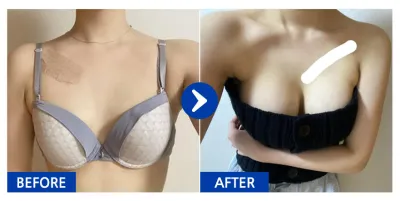 [バビトーク] 豊胸整形 / 6ヶ月目 / ニックネーム：メルリョン