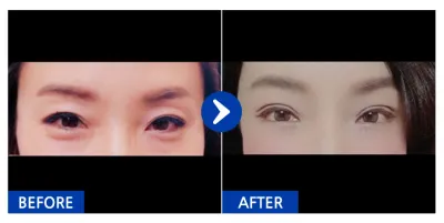 [カンナムオンニ] 上下眼瞼 / 1ヶ月目 / ニックネーム : JONABI555