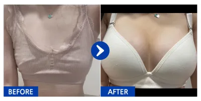 [バビトーク] 豊胸整形(セビン) / 5ヶ月目 / ニックネーム:ヒョンニヒョンニヤ