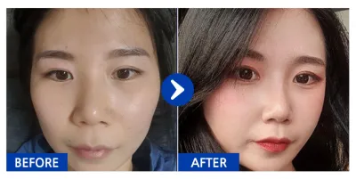 [バビトーク] 鼻整形 / 2ヶ月目 / ニックネーム：ニックネーム11111