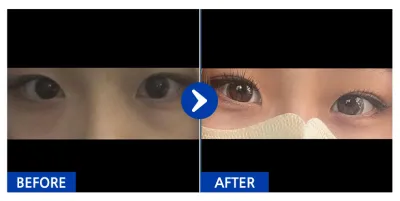 [バビトーク] 目の下、二重(埋没) / 2ヶ月目 / ニックネーム：オニオニオンディ