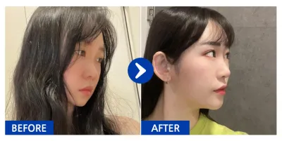 [バビトーク] 鼻整形 / 6ヶ月目 / ニックネーム：ヒョンニヒョンニヤ