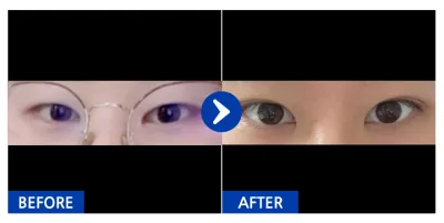 [カンナムオンニ] 二重（自然癒着） / ニックネーム：juankim