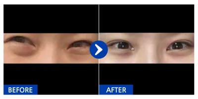 [カンナムオンニ] 目の下の脂肪再配置 / 2ヶ月目 / ニックネーム : dbgcgghgfd