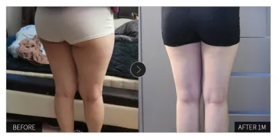 [カンナムオンニ 口コミ] 脂肪吸引 1ヶ月目 / ニックネーム：チュジョ1017