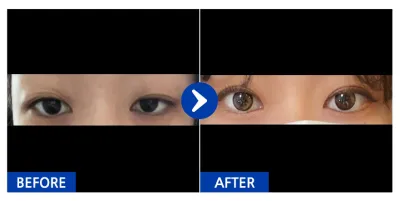 [カンナムオンニ] 二重(自然癒着) / 2週目 / ニックネーム：ヌンヌナンマナン