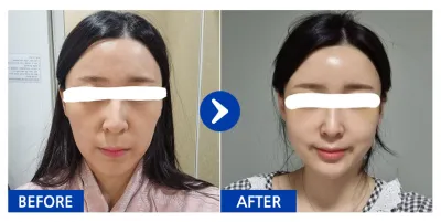 [バビトーク] 脂肪移植 / 1ヶ月目 / ニックネーム：ヨヨモンa