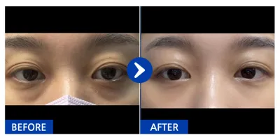 [カンナムオンニ] 目の下の脂肪再配置 / 1ヶ月目 / ニックネーム：隣のヨミ