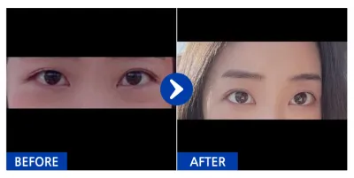 [バビトーク] 目の下の脂肪再配置 / 1ヶ月目 / ニックネーム : kd31