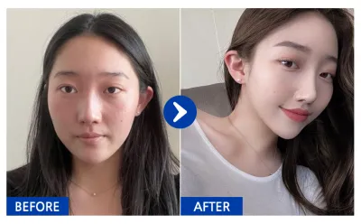 [バビトーク] 鼻整形(機能鼻+美容鼻) / 2ヶ月目 / ニックネーム : atmospe_