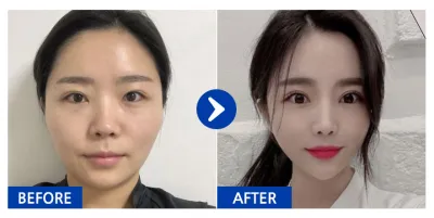 [バビトーク] 顔面輪郭 / 3ヶ月目 / ニックネーム：ムンホムン