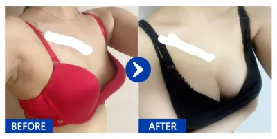 [バビトーク] 豊胸整形 / 8ヶ月目 / ニックネーム：メルリョン