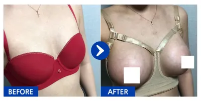 [バビトーク] 豊胸整形 / 2週目 / ニックネーム：エイミーオンニ