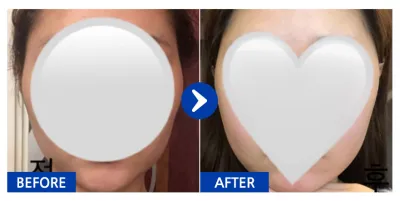 [カンナムオンニ] 輪郭整形 / 1ヶ月目 / ニックネーム: daldal2