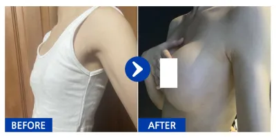 [カンナムオンニ] 豊胸(モティバ) / 1ヶ月目 / ニックネーム：チョロクホブ