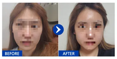 [バビトーク] 頬骨、エラ / 3週目 / ニックネーム:223345