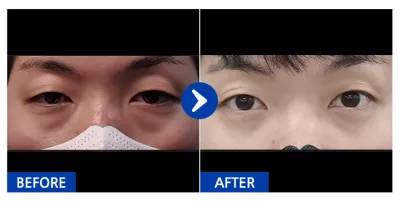 [バビトーク] 目の下の脂肪再配置 / 1ヶ月目 / ニックネーム:ヒョデュリ