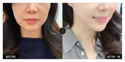 [カンナムオンニ 口コミ] 糸リフト 1ヶ月目 / ニックネーム：sooeu