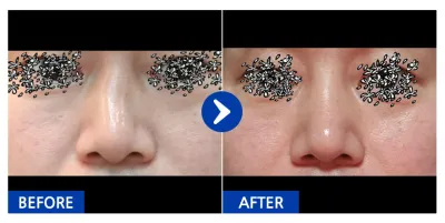 [バビトク] 鼻整形 / 1ヶ月目 / ニックネーム:スーパーチュ