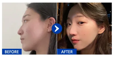 [バビトーク] 鼻整形 / 1年目 / ニックネーム:atmospe