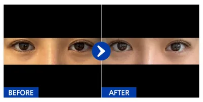 [カンナムオンニ] 目の下の脂肪再配置 / 1ヶ月目 / ニックネーム: OooOwa