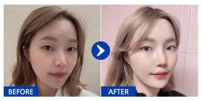 [カンナムオンニ] 鼻再手術 / 1ヶ月目 / ニックネーム: ohnee5