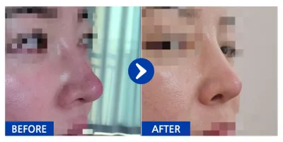 [バビトーク] 鼻再手術 / 1ヶ月目 / ニックネーム：コアラチチ