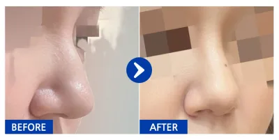 [カンナムオンニ] 鼻再手術 / 1ヶ月目 / ニックネーム: jjjejjj