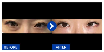 [バビトーク] 目の下の脂肪再配置 / 1ヶ月目 / ニックネーム: yoouii