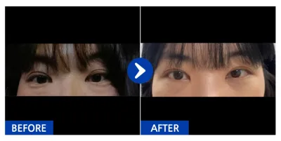 [カンナムオンニ] 目の下の脂肪再配置 / 1ヶ月目 / ニックネーム: キム〇ヒョン