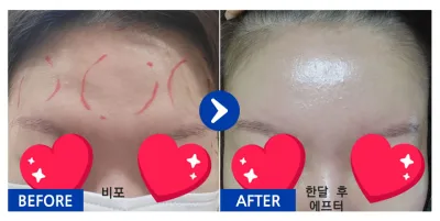 [バビトーク] 額脂肪移植 / 1ヶ月目 / ニックネーム：パパロン